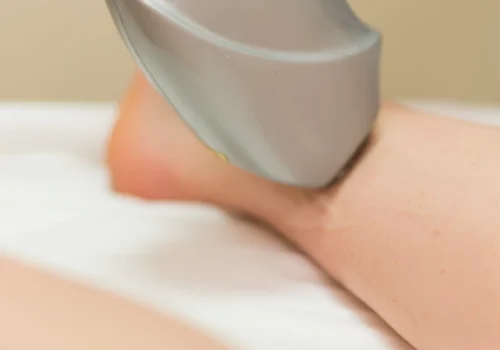 lazerinis-venu-varikozes-gydymas-642x1024-1