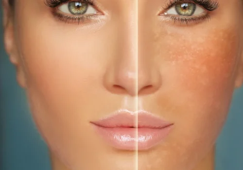 melasma-642x1024
