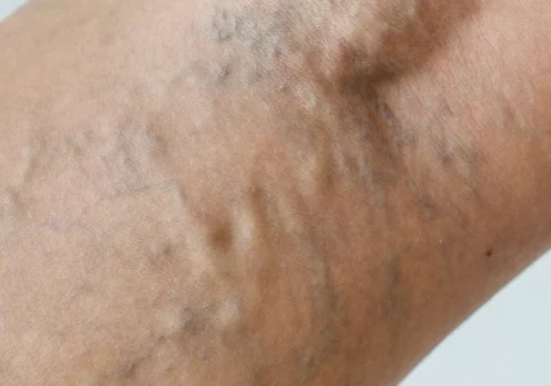 venu-varikoze-642x1024-1